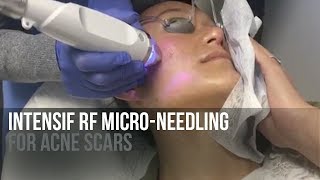 Intensif RF Microneedling For Acne Scars | LIVE