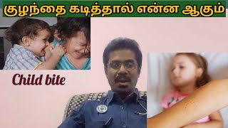 குழந்தைகள் கடித்தால் என்ன செய்யணும்? | how to approach child bite #care #tamil #health #viral