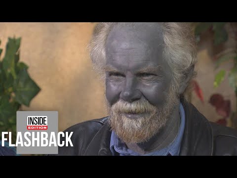 Why did this man's skin turn blue?