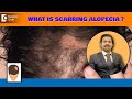 6 Causes Why NO HAIR GROWTH after Hair Treatment|Scarring Alopecia-Dr.Deepak Devakar|Doctors' Circle