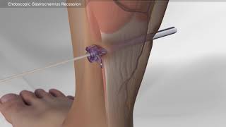 Endoscopic Gastrocnemius Recession