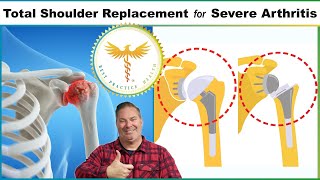 Doctor explains the Best Total Shoulder Replacement Procedures for Severe Arthritis