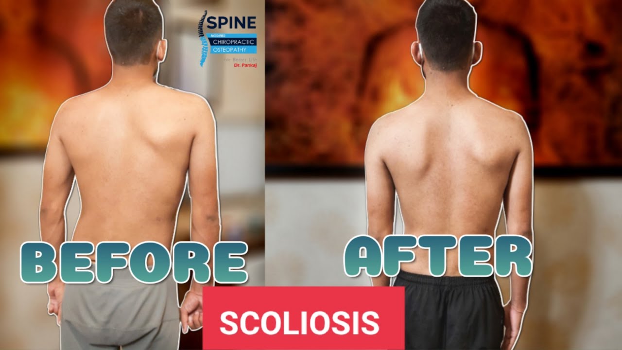 Scoliosis| Scoliosis Treatment In India| Chiropractor In India # ...