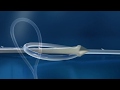 V-Loc™ Wound Closure Device Steps-for-Use Video