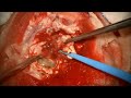 surgical removal of malignant brain tumor glioblastoma gyrectomy with trans sulcal approach