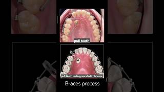 how to pull teeth underground when braces? #braces #orthodontist #dentist #dental #shorts #viral