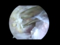 Arthroscopic SSn Release Dr  Jeffrey E Budoff Katy TX