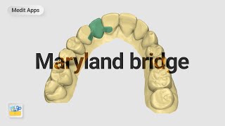 Designing a Maryland Bridge with the Medit Design App