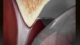 Metal-on-Metal Hip Replacement Recall Animation