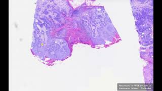 Squamous cell carcinoma in a dog // Histopathology // Vanessa Herder