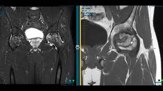 AVN bilateral hips in 26 year old