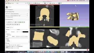 3D Slicer Tutorial: How to Segment a Lumbar Vertebrae