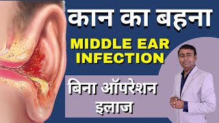 कान का बहना Middle ear infection बिना ऑपरेशन इलाज