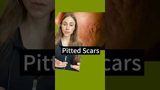 Real Facts About Acne Scars #dermatologist