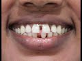 Smile makeover/ Cosmetic dentistry by Dr Trivikram Bangalore