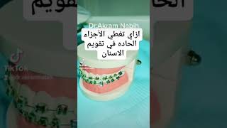 حل الأجزاء الحاده من تقويم الاسنان شمع التقويم  #braces  #تقويم_اسنان #orthodontist #orthodontics