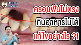 ครอบฟันไม่ตรง เคี้ยวอาหารไม่ได้ แก้อย่างไร อันตรายมาก ?!! | คลายปัญหารากเทียมกับหมอโชค