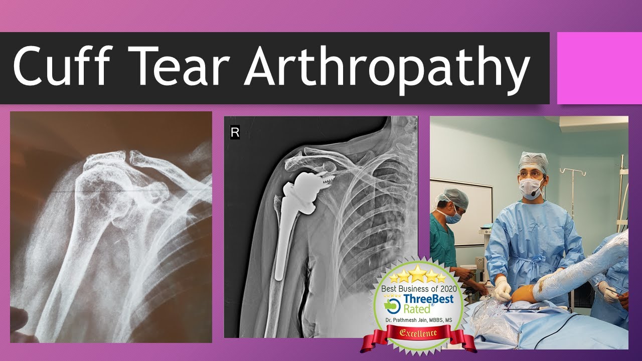 Shoulder Rotator Cuff Tear Arthropathy English - YouTube