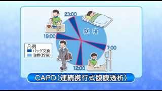 腹膜透析（CAPD）