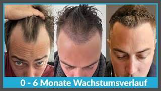 Die ersten 6 MONATE nach einer Haartransplantation: Wie DICHT sollte es sein?