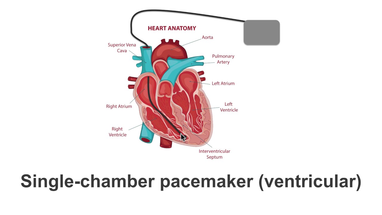 Pacemaker Varieties: Single To Biventricular Explained - YouTube