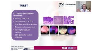 Urowebinar: BCG unresponsive disease how this definition impact your treatment decision making