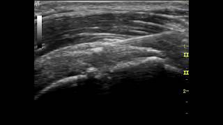 Ultrasound - guided shoulder injection.