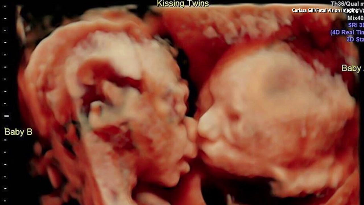 Ultrasound Captures Sweet Moment Between Twins In The Womb - YouTube