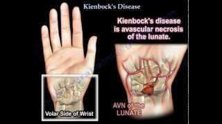 Kienbock's Disease - Everything You Need To Know - Dr. Nabil Ebraheim
