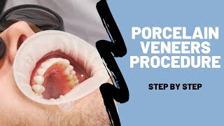 Porcelain Veneers Procedure Breakdown