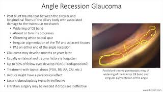 Lecture: Angle Recession Glaucoma (1 Slide in 5 Minutes)