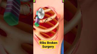 Ribs Broken Surgery| ASMR Treatment| #shorts #viralshorts #ytshorts #asmrvideo #relaxing #asmr