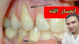 هل يمكن للثه المنحسره او المتراجعه ان تنمو مره اخري؟