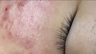 Sac Dep Spa Acne Treatment | Acne Blackhead Removal Process