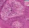 Histopathology Breast--Paget disease