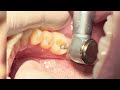 teeth composite restoration after deep caries cleaning