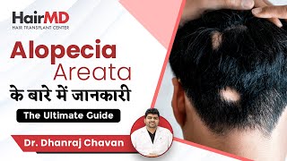 Ultimate Alopecia Areata Guide | Alopecia Areata के बारे में जानकारी | HairMD, P