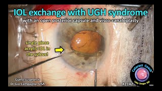 मोतियाबिंदकोच™ 2142: यूजीएच सिंड्रोम और कैनालोप्लास्टी के साथ आईओएल एक्सचेंज