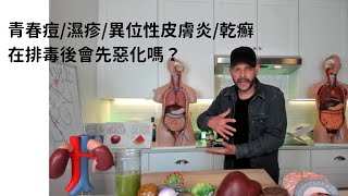 青春痘＆濕疹在開始排毒後會先惡化嗎？ Medical Medium on do acne and eczema getting worse after detox?