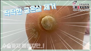 [레푸스 구미상모1호점] 10번도 넘게 수술, 대왕굳은살 제거 2차관리 오셨어요