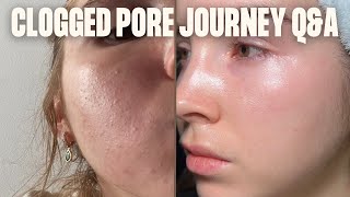 CLOSED COMEDONES | Q\u0026A Clogged pores \u0026 my retinoid journey