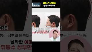 뒤통수가 납작해서 평생 스트레스?!!  #두상필러전후 #두상필러실사례 #두상필러