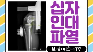 십자인대파열 증상과 수술 후 장해진단서 신청시 유의점(29회)