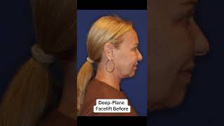 Deep-Plane Face \u0026 Neck Lift Results | Facial Plastic Surgeon NYC