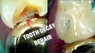 [49] Live Tooth Decay Repair Procedure (27MO)