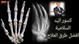 كسور اليد و السلامية احسن طريقة لعلاج كسور اليد ؟