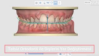 TELSİZ ORTODONTİ