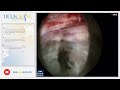 Laser Spine Surgery - Herniated Discs - Back Pain - LT L4-L5, RT L5-S1