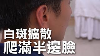 白斑擴散半邊臉 陷入藍色憂鬱