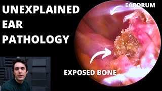 Benign Necrotising Otitis Externa (3 cases)